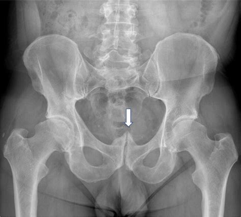 5) and were less prominent than findings in the sacroiliac joints. . Degenerative changes in symphysis pubis radiology